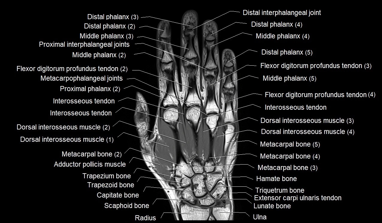 MRI 3T coronal hand cross sectional anatomy image 11.webp